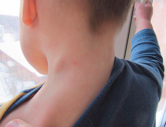 5 признаков аллергии у ребенка, если его покусали блохи. Какой мазью пользоваться