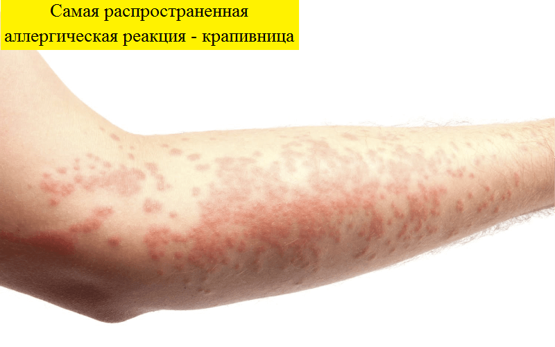 Аллергия на укусы блох, как проявляется аллергическая реакция?