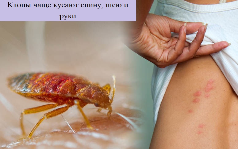Чем отличается укус клопа от укус комара, какие могут быть последствия?