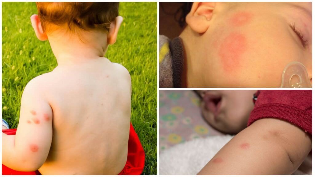 Ребенка покусали комары, куда обратиться и чем лечить?