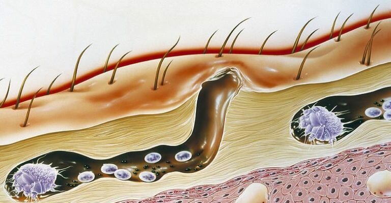 Подкожные вши на голове у человека, почему они там живут и как избавиться?