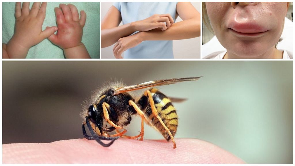 Аллергия на укус осы беременным thumbnail