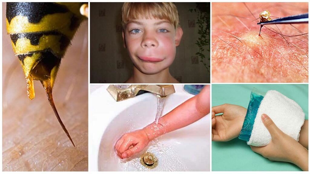 Что делать если ребенка укусила (ужалила) оса в палец, руку, лицо, шею, ногу
