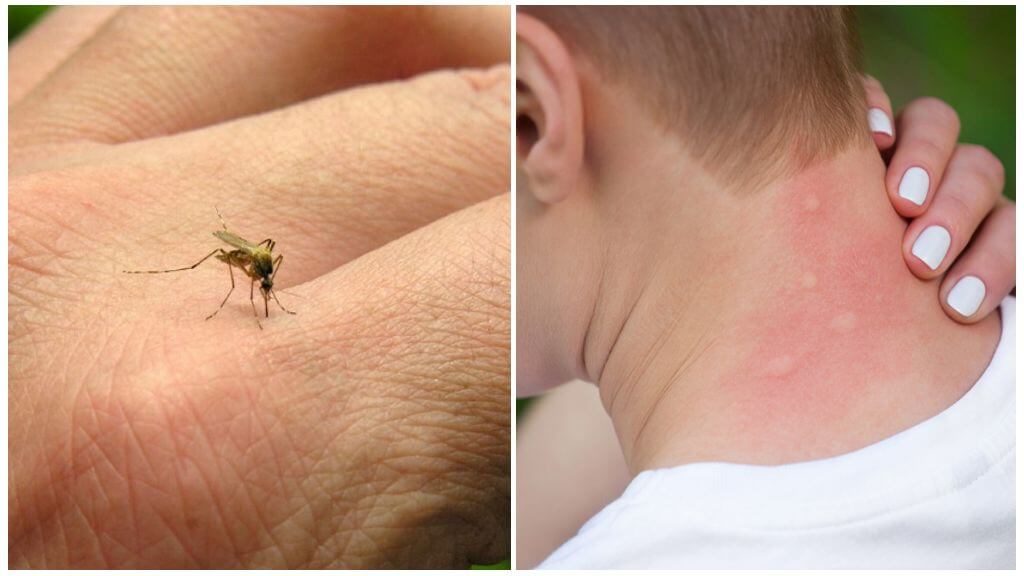 Почему укусы комаров опухло лицо thumbnail