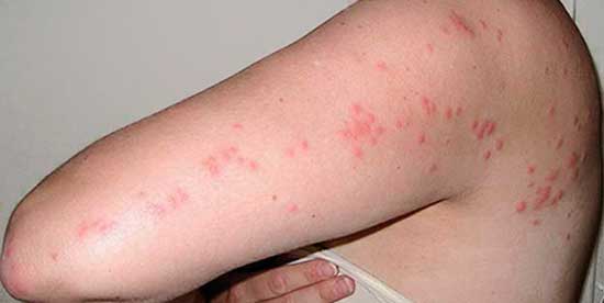 Аллергия на бельевых клещей фото